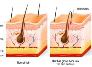 ingrown beard hair illustration